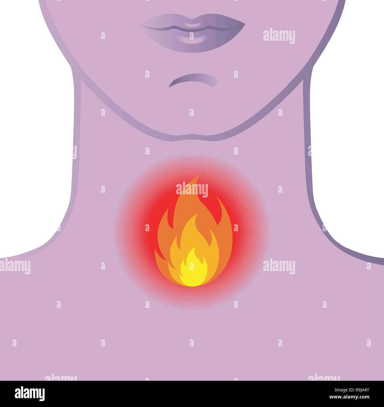 Une illustration médicale symbolique d'une gorge en feu. Illustration de Vecteur