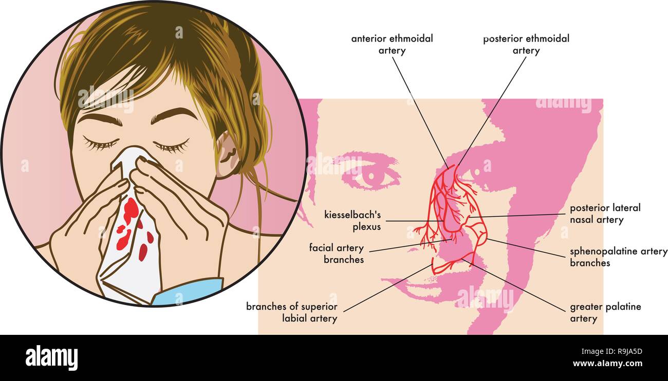 Illustration médicale des symptômes de l'épistaxis (saignements de nez). Illustration de Vecteur