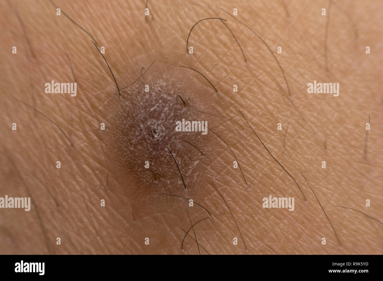 Close up scar (cicatrice hypertrophique chéloïdes) sur la peau Banque D'Images