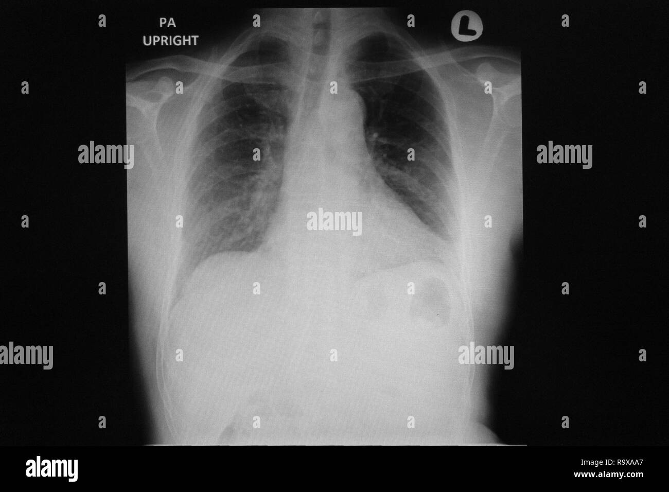 La radiographie du thorax droit Banque D'Images