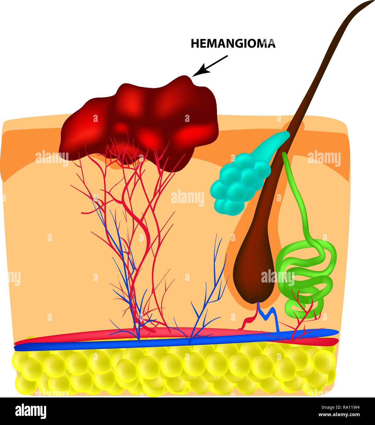 Hemangeoma Structure. La structure de la taupe rouge sur la peau. Tâche de naissance. L'infographie. Vector illustration sur fond isolé Illustration de Vecteur