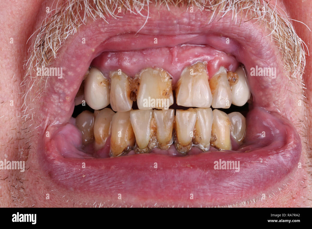 Les dents d'un homme âgé sont gâtés par les caries, le tartre et la mauvaise alimentation déchets macro. Les méfaits de l'alcool et le tabac. Macro Studio shot Banque D'Images