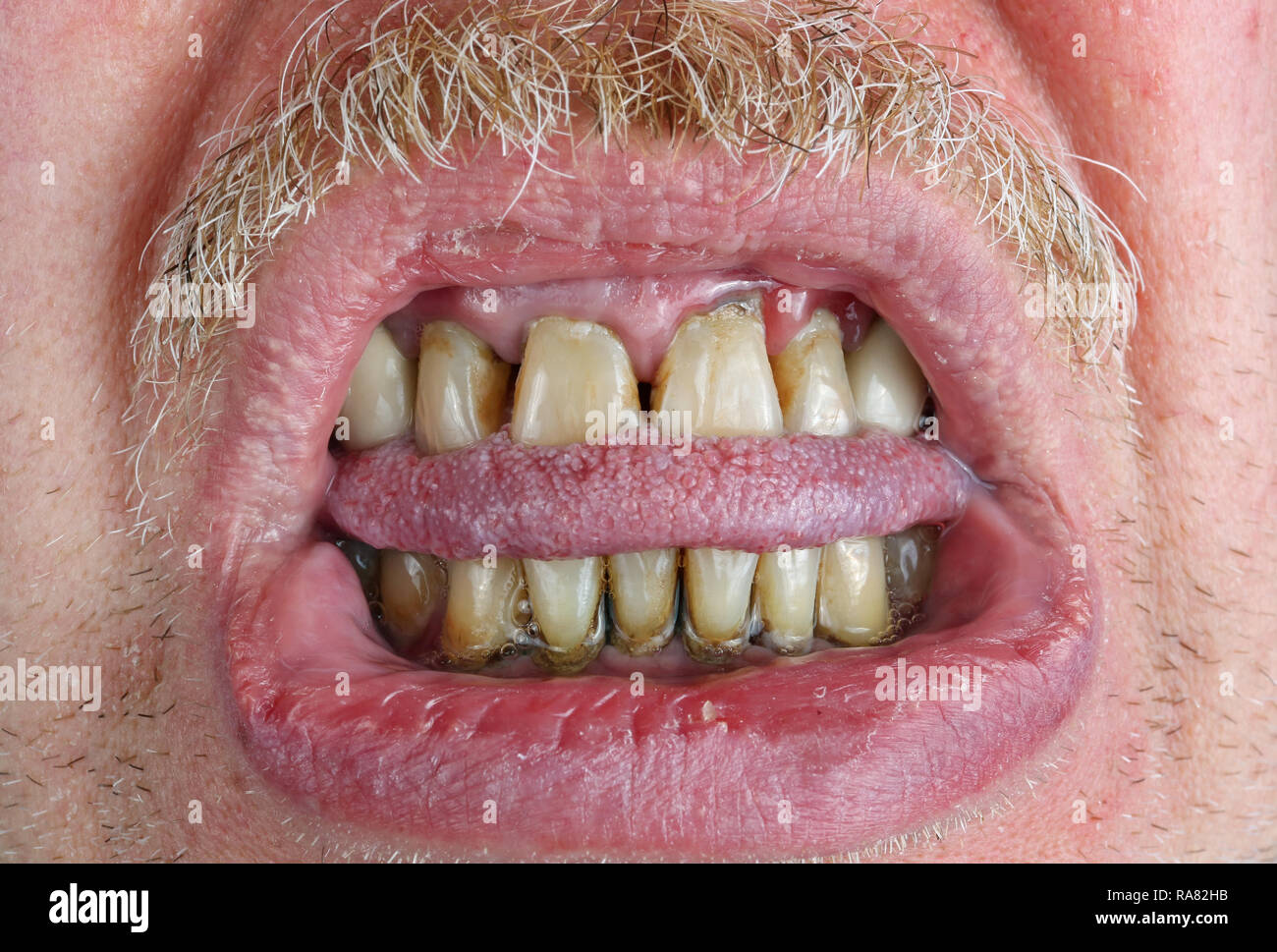 Les dents Jaunes et la moustache, mordu la langue et lèvres sèches dans un vieil homme âgé macro. Les méfaits de l'alcool et le tabac. Macro Studio shot Banque D'Images