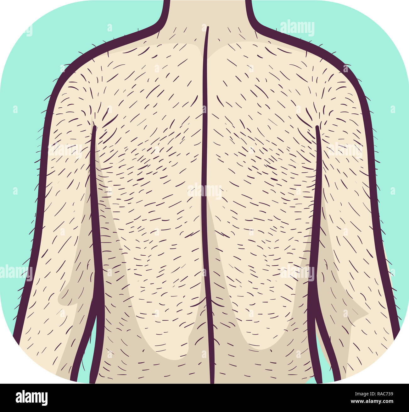 Illustration d'un homme poilu excessive avec dos et vos bras. Problème de  santé de l'hypertrichose Photo Stock - Alamy
