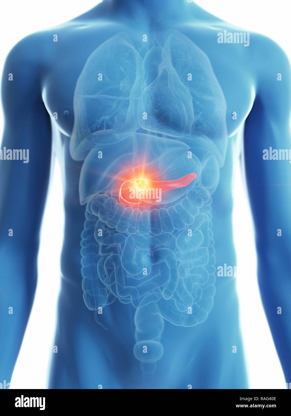 Illustration d'un cancer du pancréas de l'homme. Banque D'Images