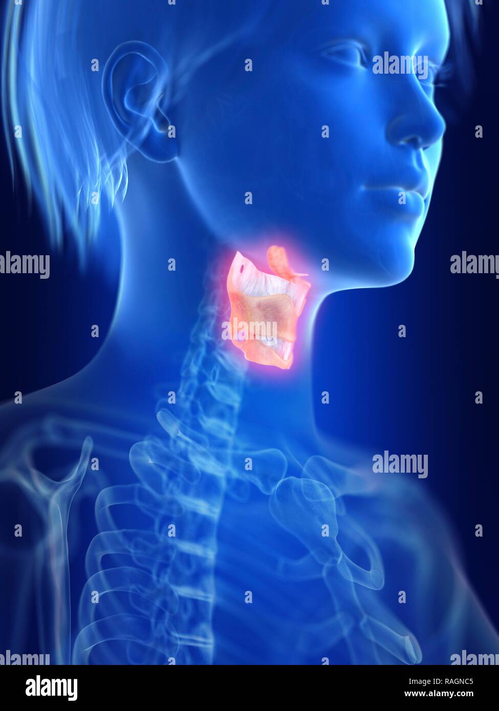 Illustration d'une inflammation du larynx. Banque D'Images