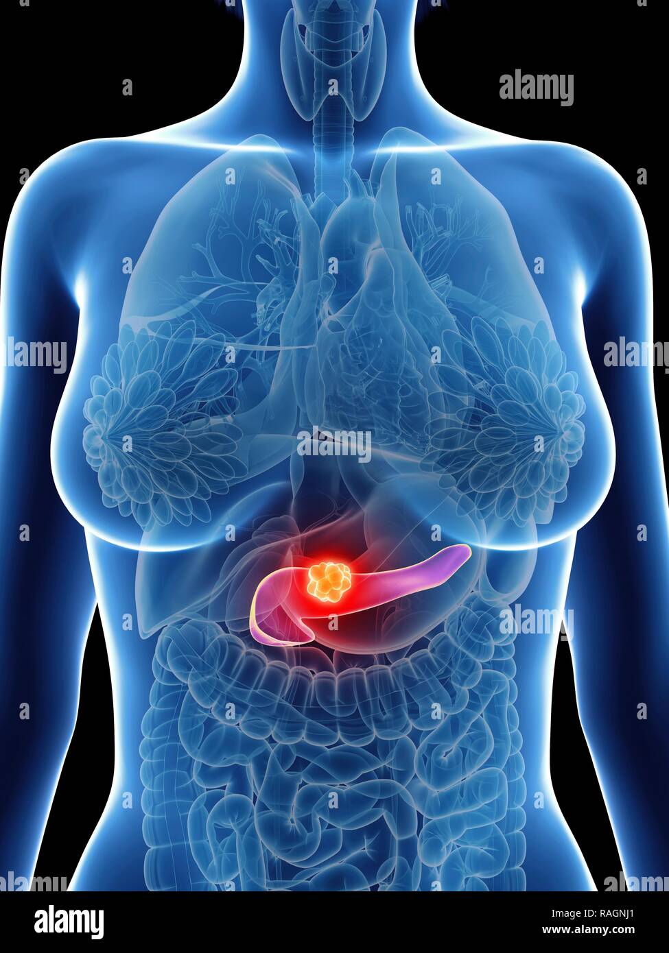 Illustration d'une femme de cancer du pancréas. Banque D'Images