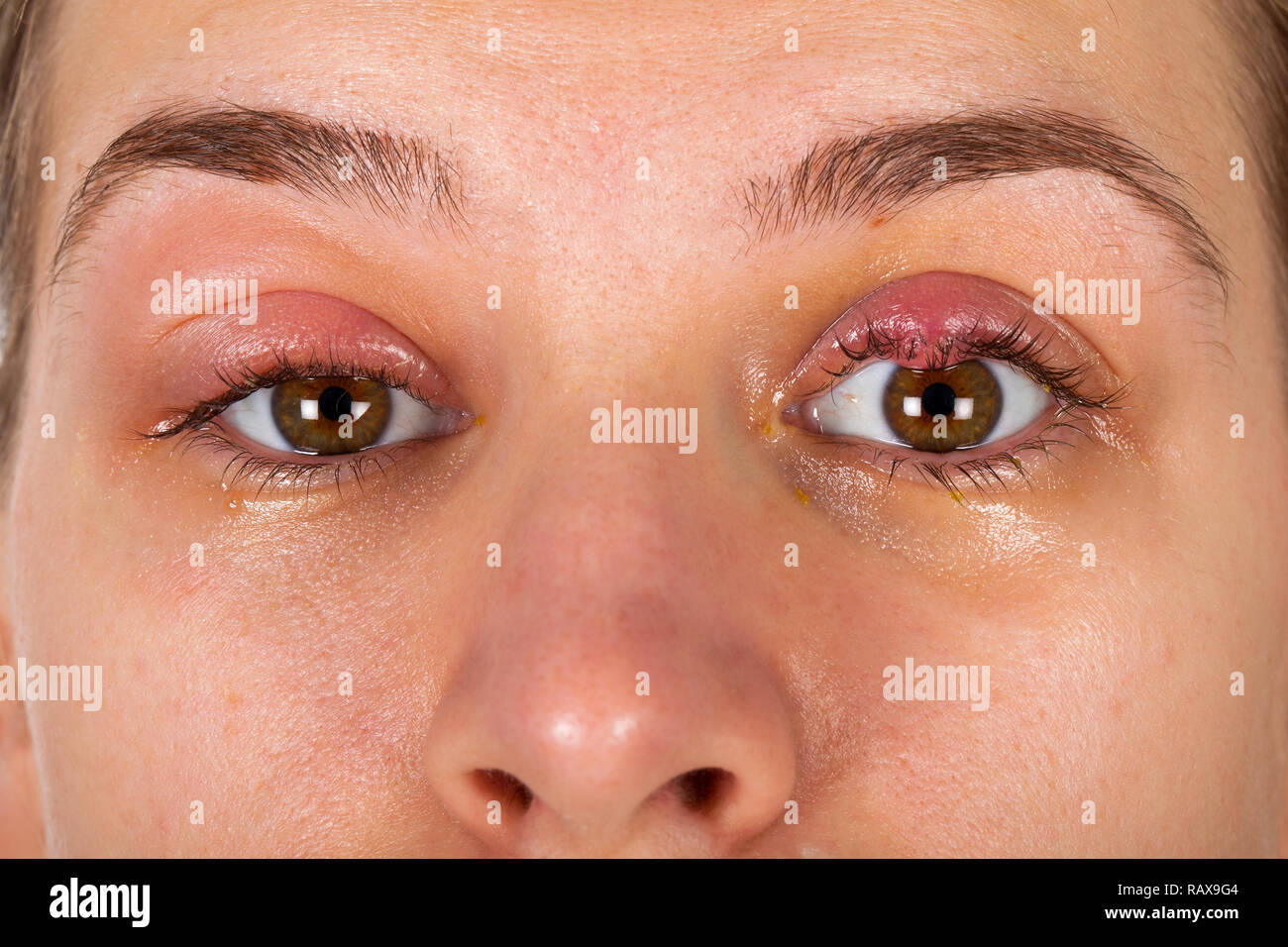 Close up photo de l'inflammation des paupières supérieures - chalazion - jeunes femmes souffrant d'une infection virale Banque D'Images