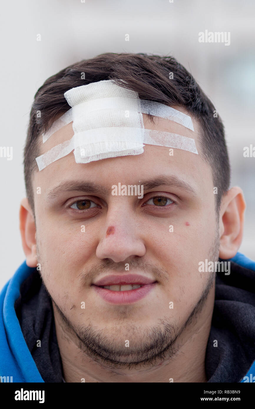 Blessure au crâne avec Suture, fils de couture craniectomy postopératoire avec beaucoup d'agrafes, de la technologie médicale la couture. Banque D'Images