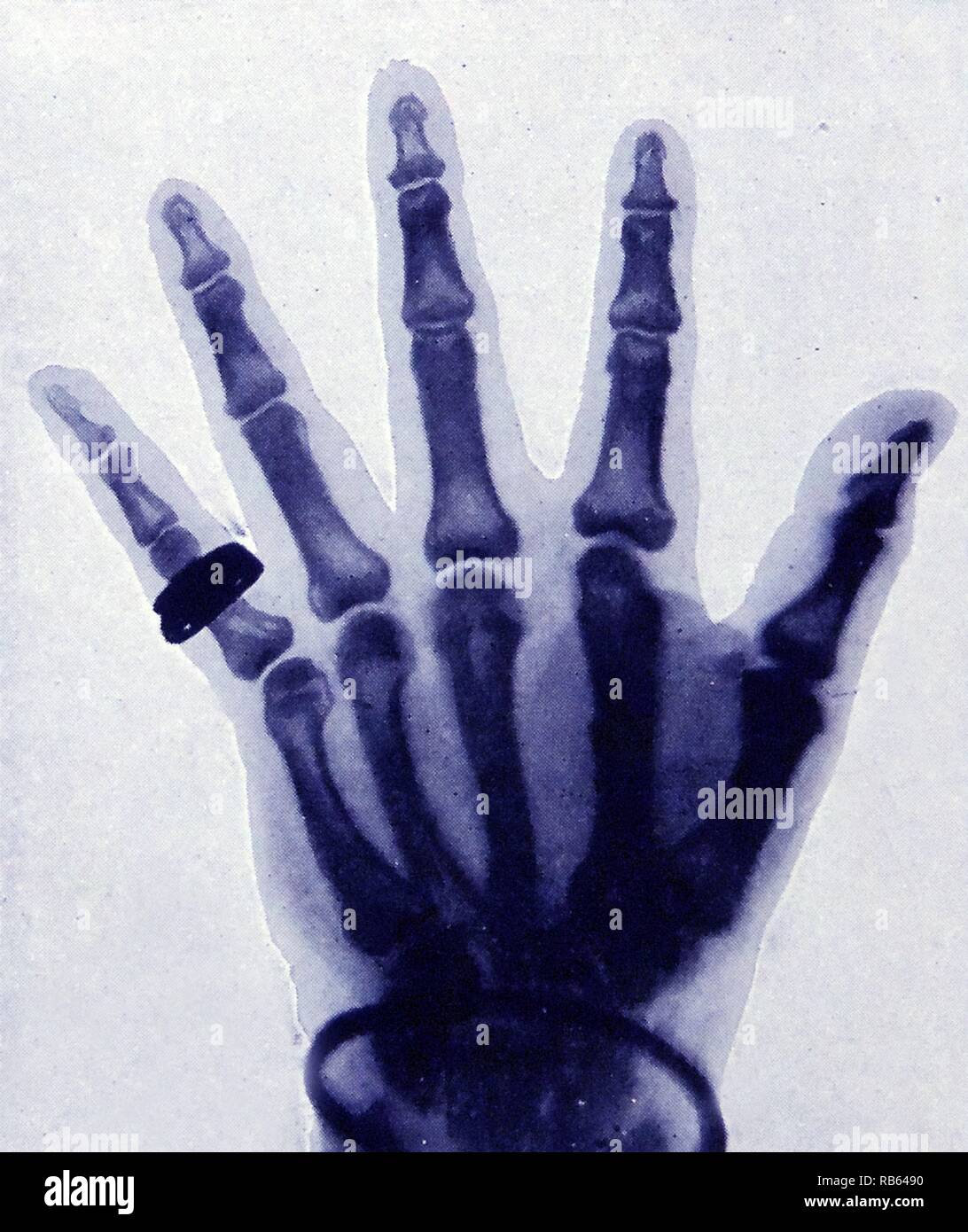 X-Ray présentation en demi-teinte d'une main pleine avec bague a été inclus dans le budget de février 1896, question de la revue photographique allemande Photographische Rundschau. Banque D'Images