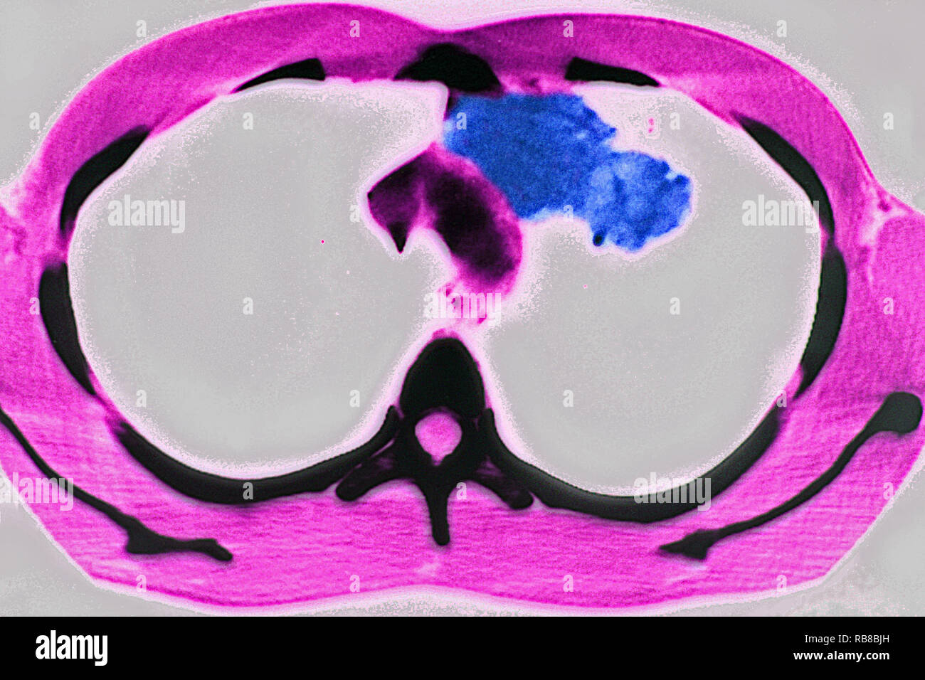 La tuberculose pulmonaire, CT-SCAN Banque D'Images