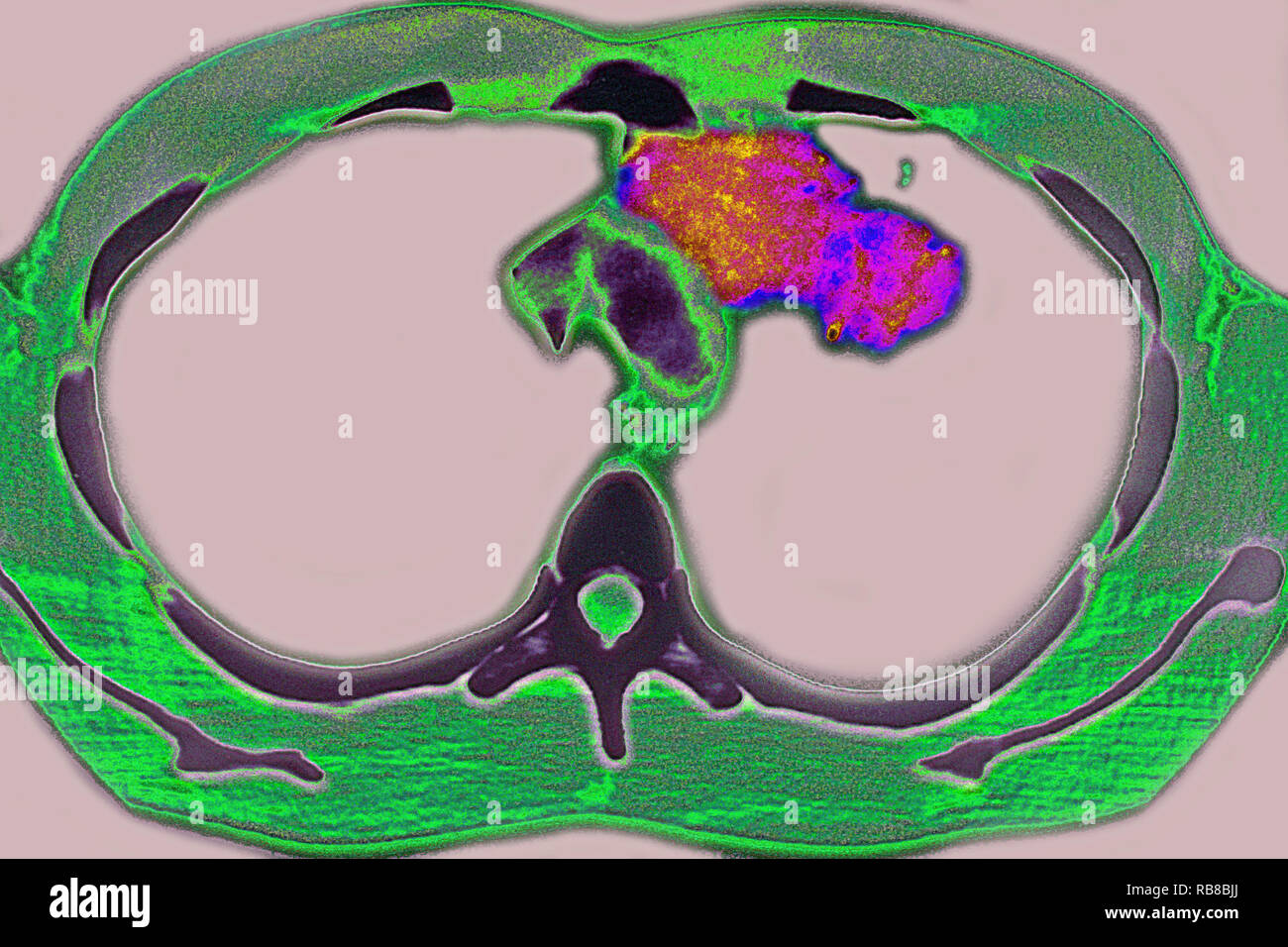 La tuberculose pulmonaire, CT-SCAN Banque D'Images