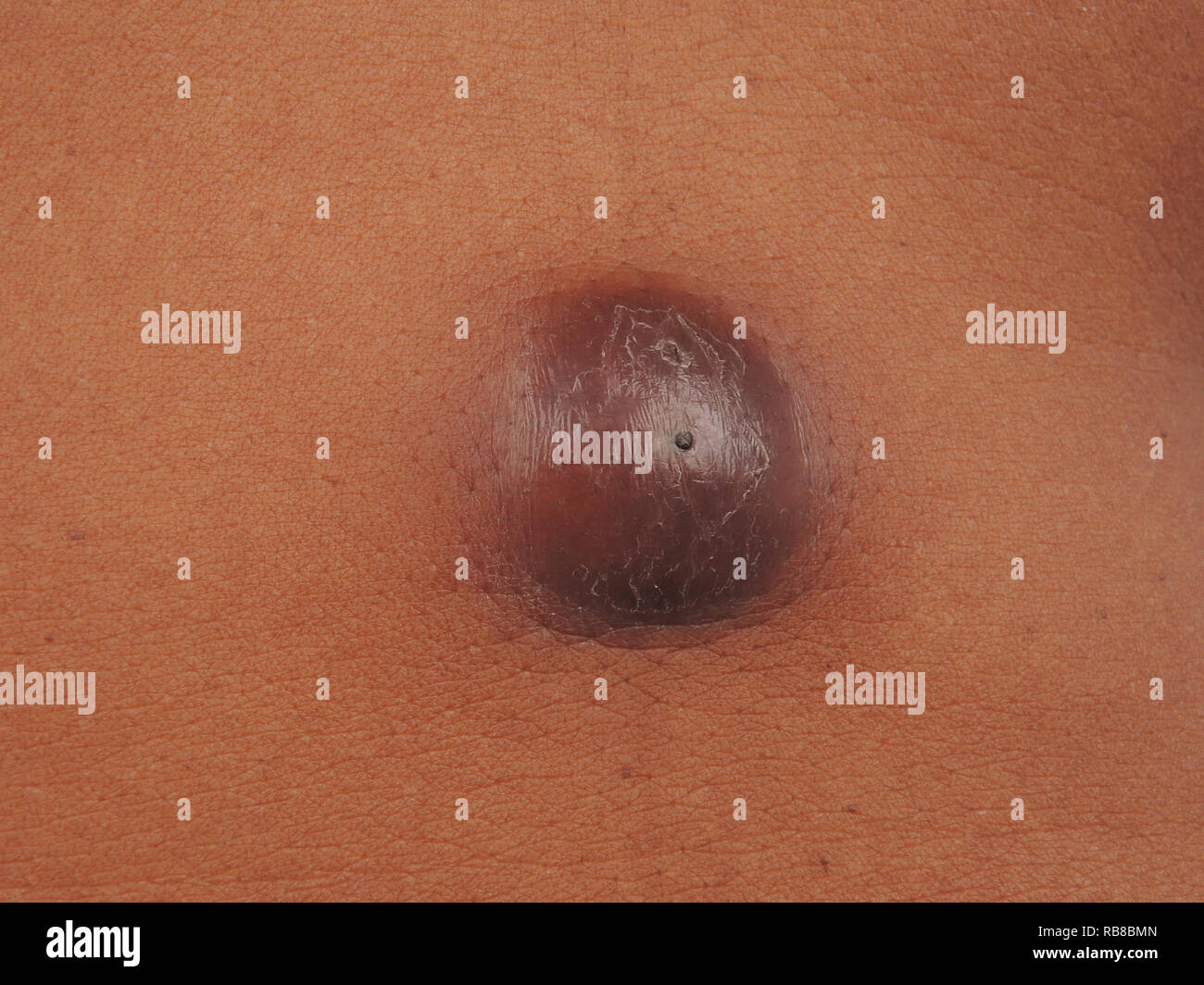 Sebaceous cysts Banque de photographies et d’images à haute résolution ...