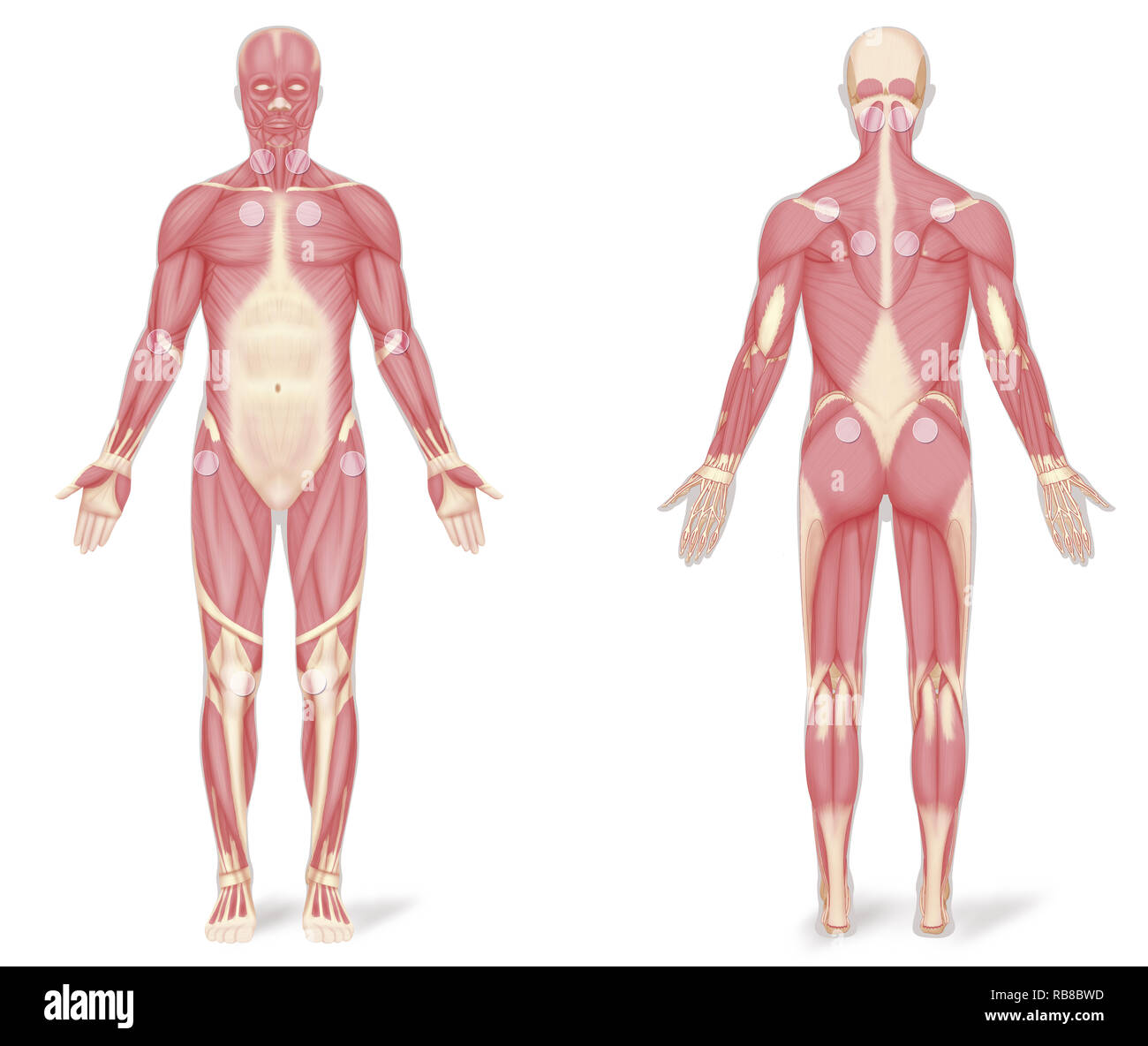 La fibromyalgie, dessin Banque D'Images