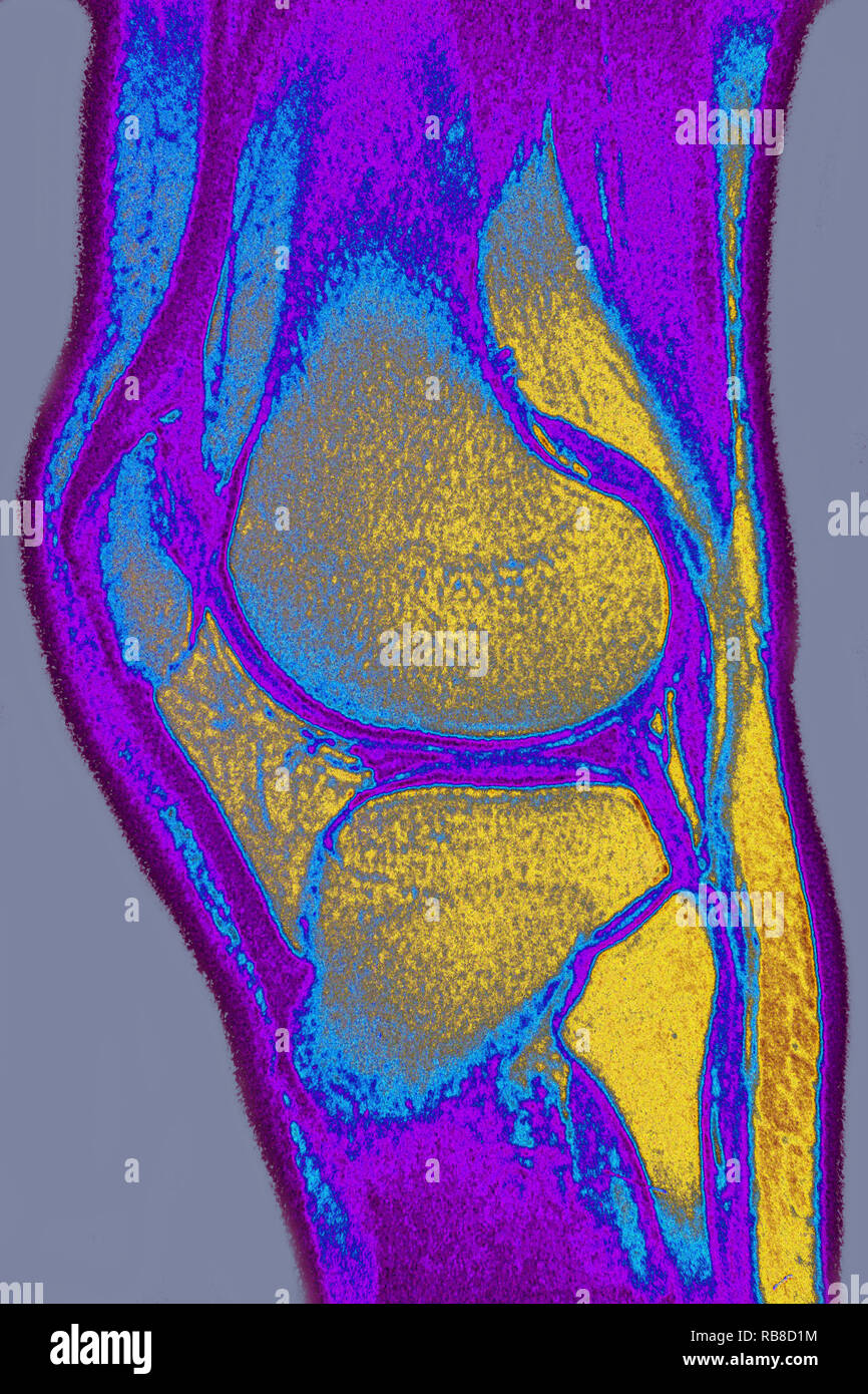 Irm du genou Normal Banque D'Images