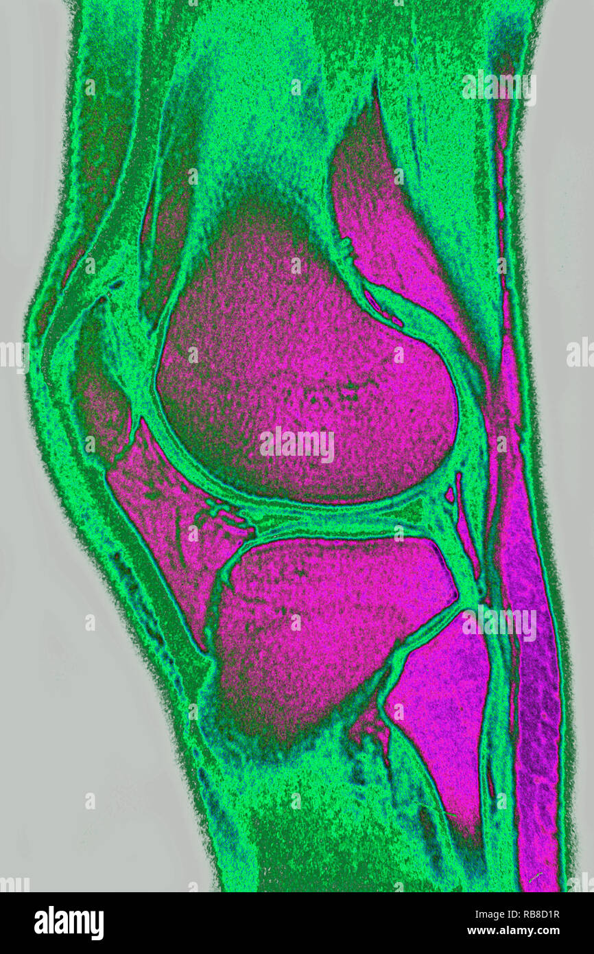 Irm du genou Normal Banque D'Images
