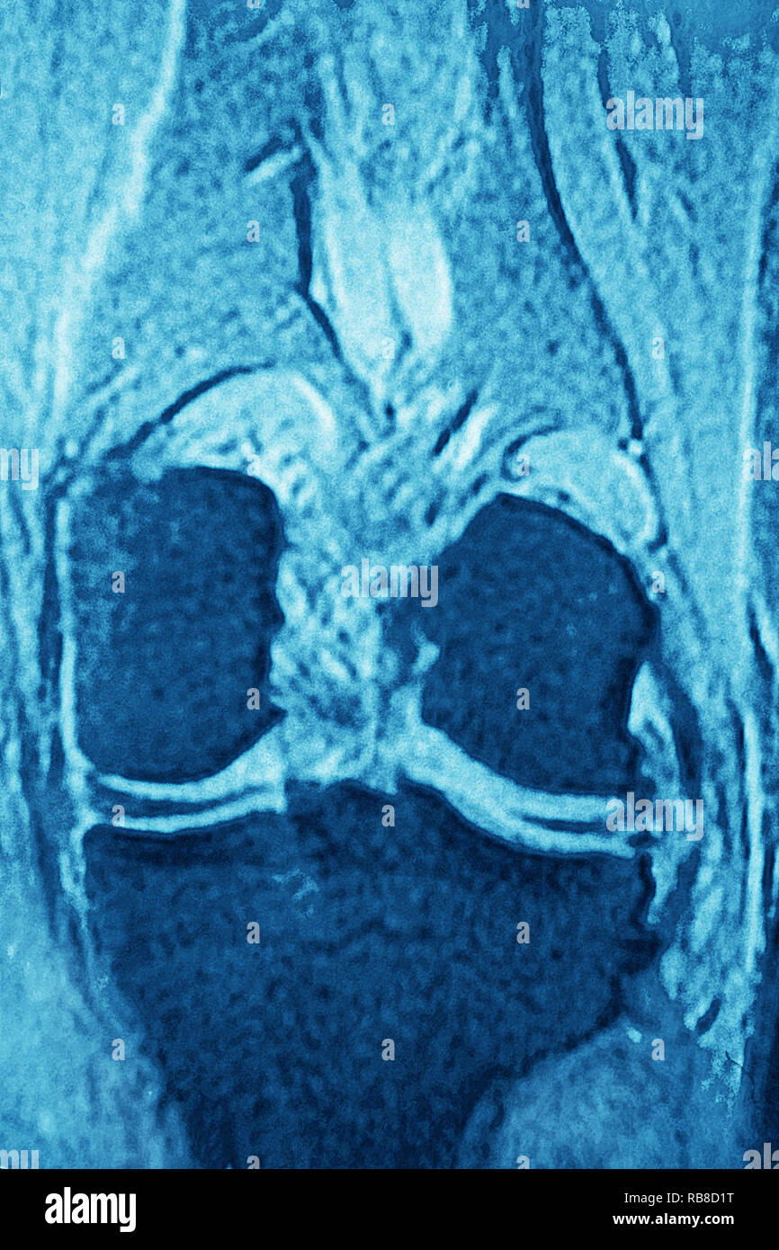 Irm du genou Normal Banque D'Images