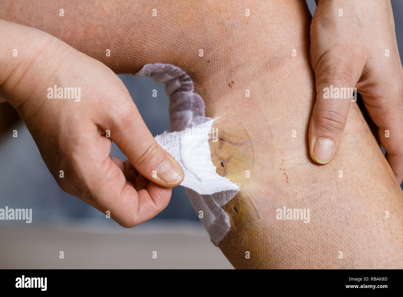 Woman bandages et l'inspection de sa jambe après chirurgie des varices, avec blessures visibles. Le traitement curatif, procédures esthétiques, thrombose Banque D'Images