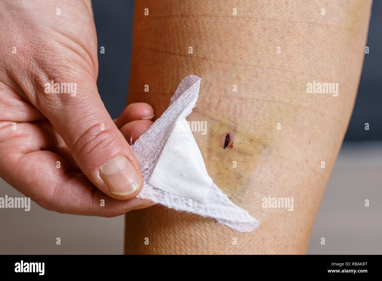 Woman bandages et l'inspection de sa jambe après chirurgie des varices, avec blessures visibles. Le traitement curatif, procédures esthétiques, thrombose Banque D'Images