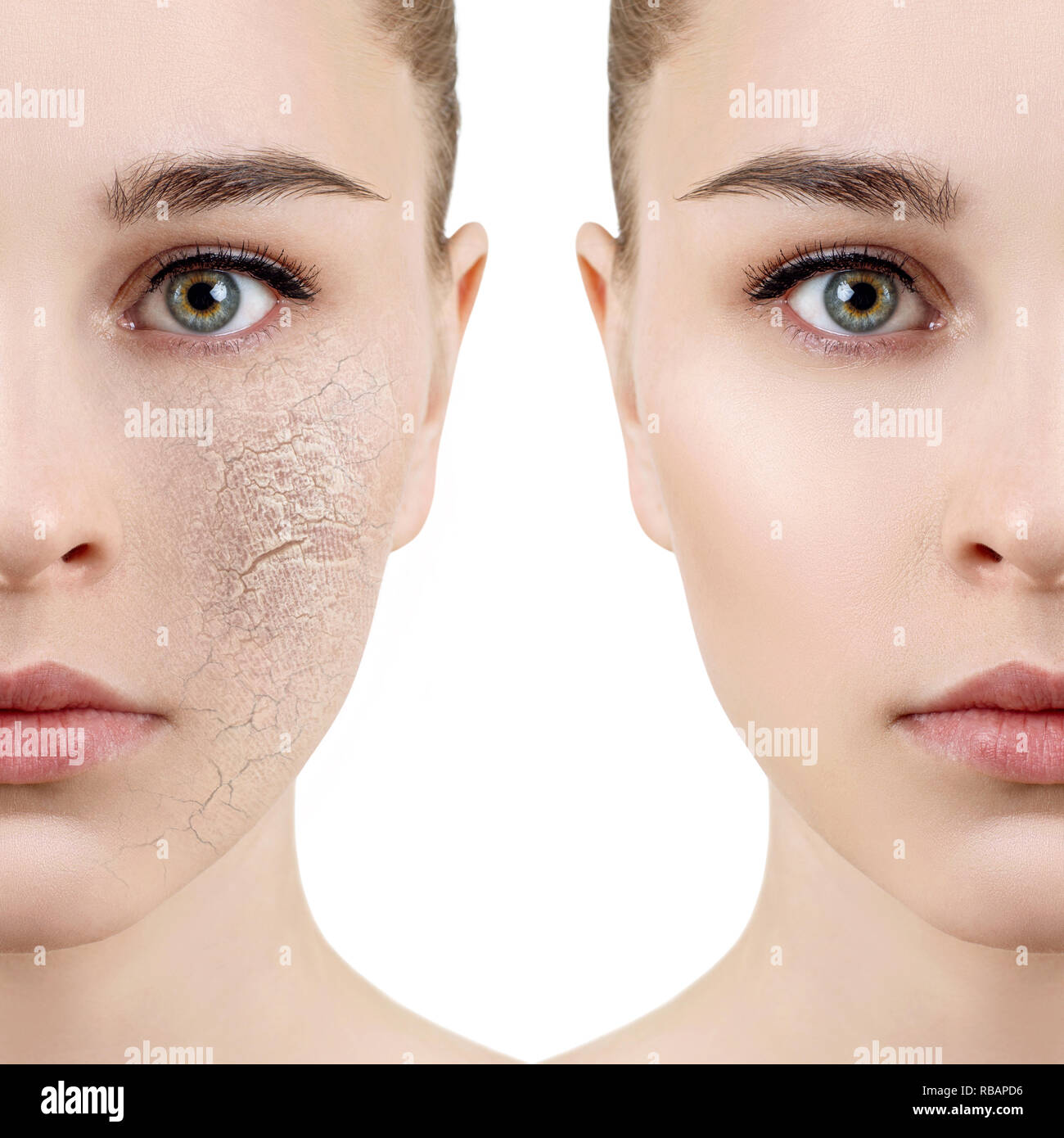Jeune femme avec la peau déshydratée, avant et après le traitement. Isolé sur blanc Photo Stock