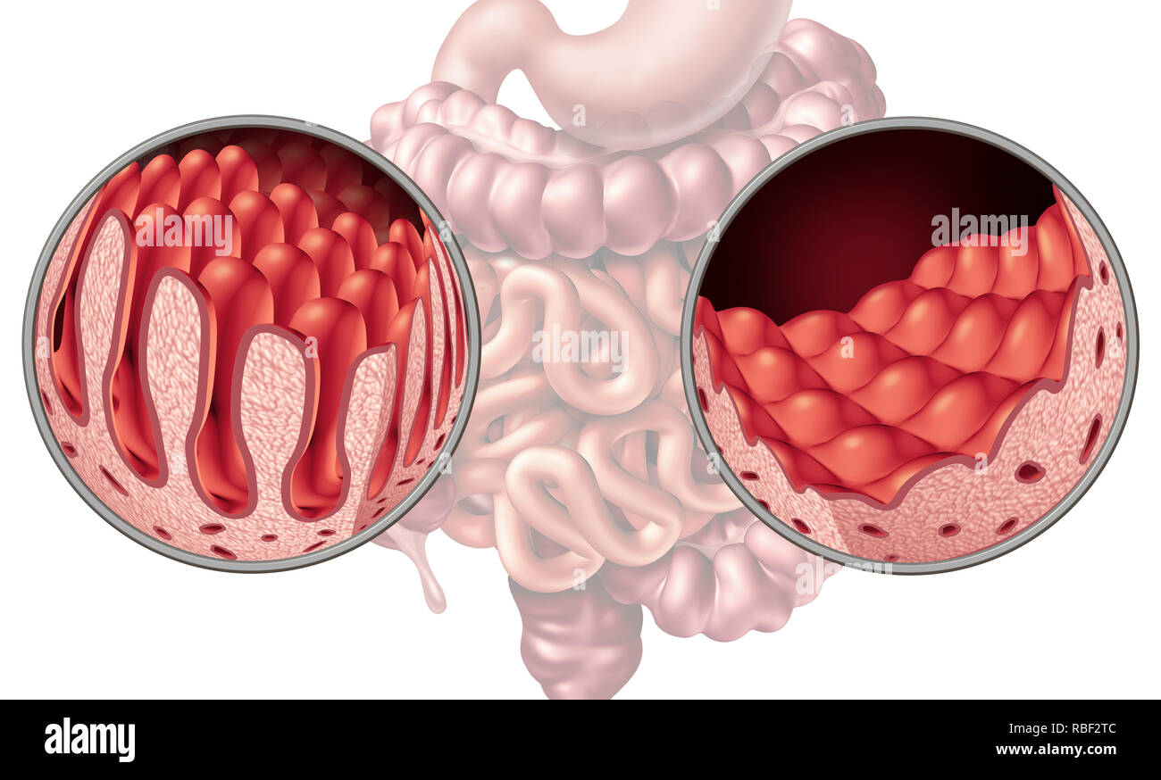 La maladie cœliaque la maladie coeliaque ou intestin anatomie medical concept avec villi normal et de l'intestin grêle endommagé comme doublure d'une maladie auto-immune. Banque D'Images