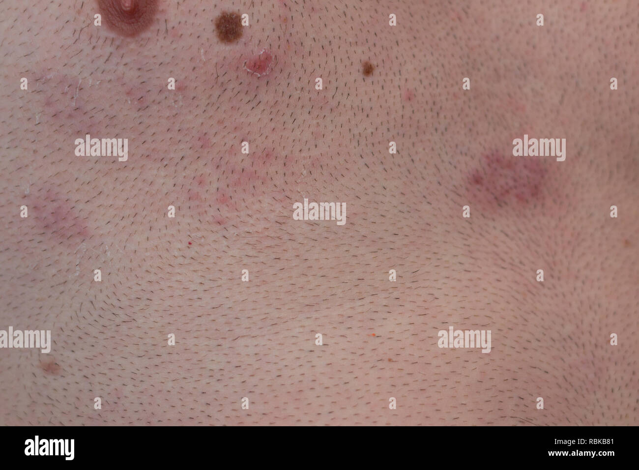 Le zona, herpès zoster, cloques sur le corps, le virus varicelle-zona, irritation de la peau Banque D'Images Le zona, herpès zoster, cloques sur le corps, le virus varicelle-zona, irritation de la peau Banque D'Images