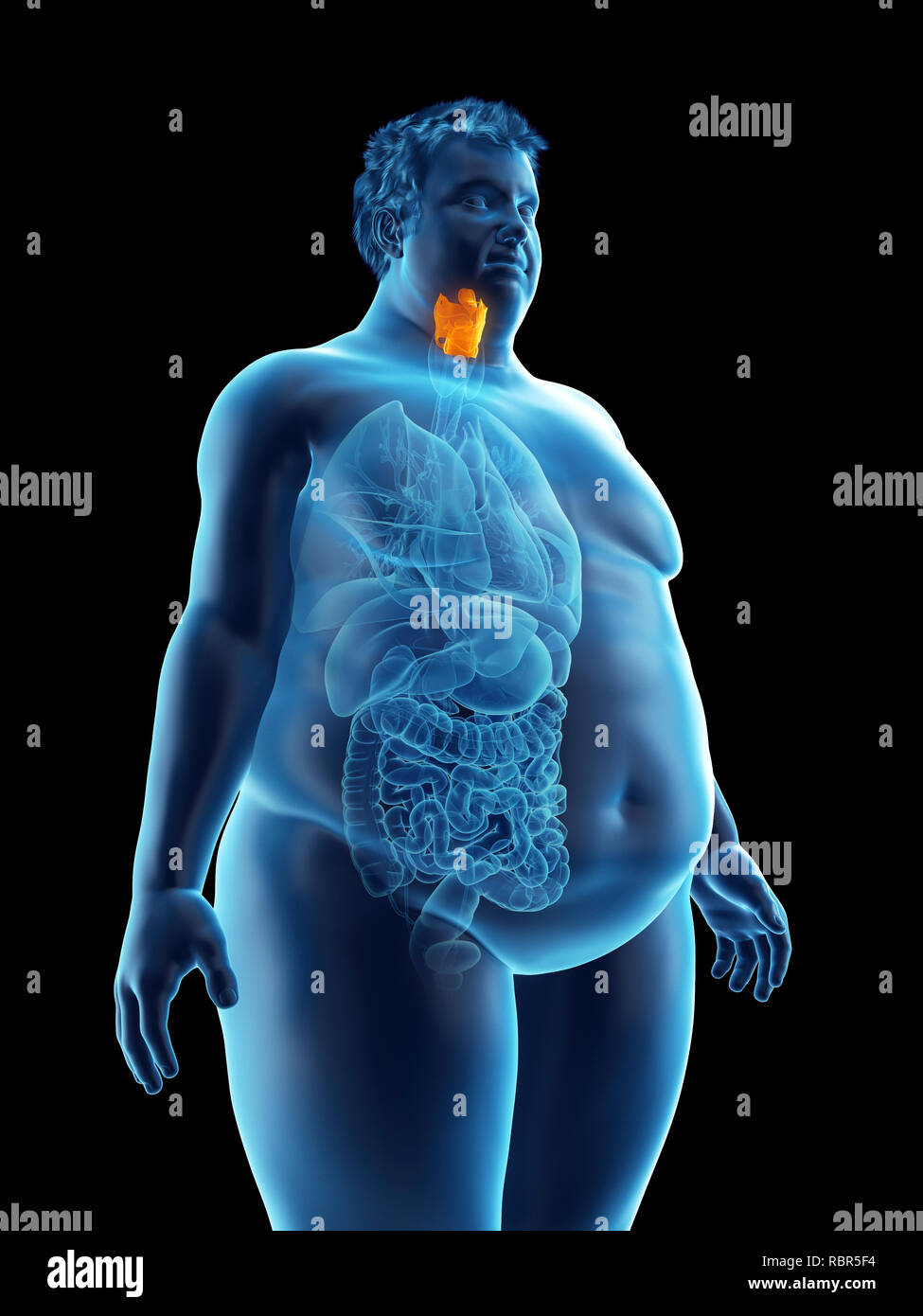 Illustration d'un larynx de l'homme obèse. Banque D'Images