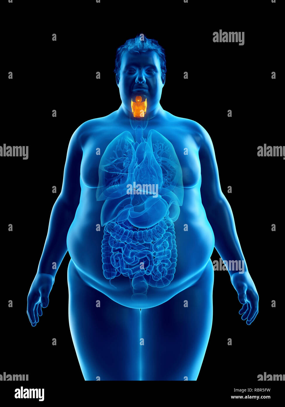 Illustration d'un larynx de l'homme obèse. Banque D'Images