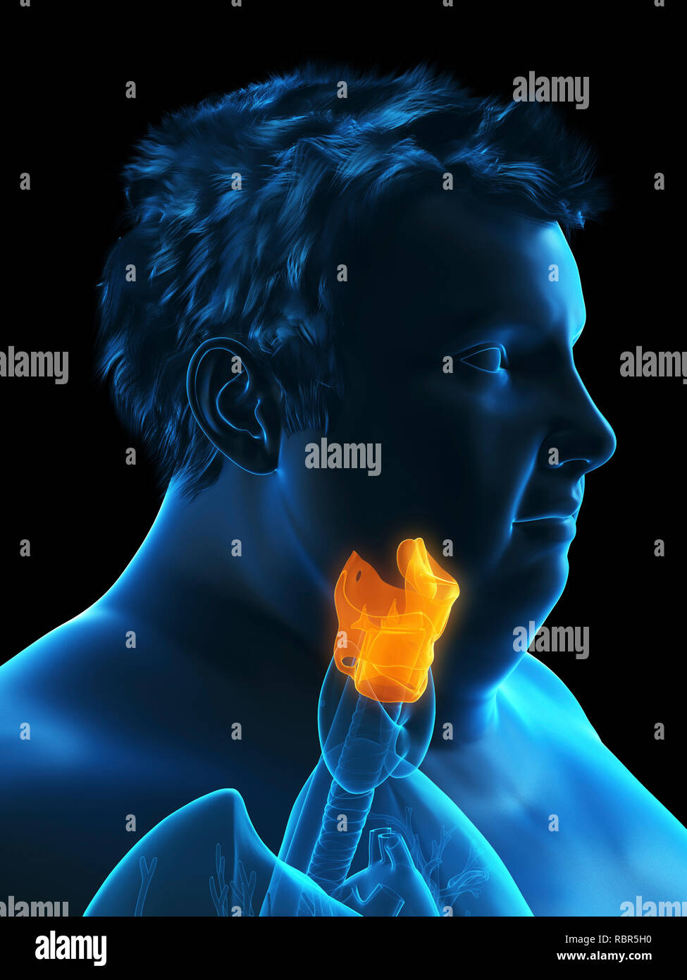 Illustration d'un larynx de l'homme obèse. Banque D'Images