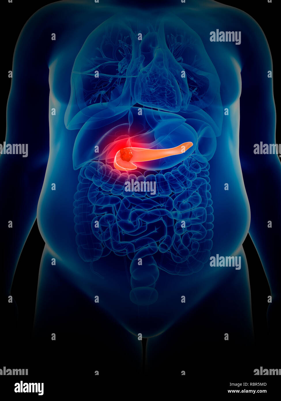 Pancreas cancer Banque de photographies et d’images à haute résolution ...