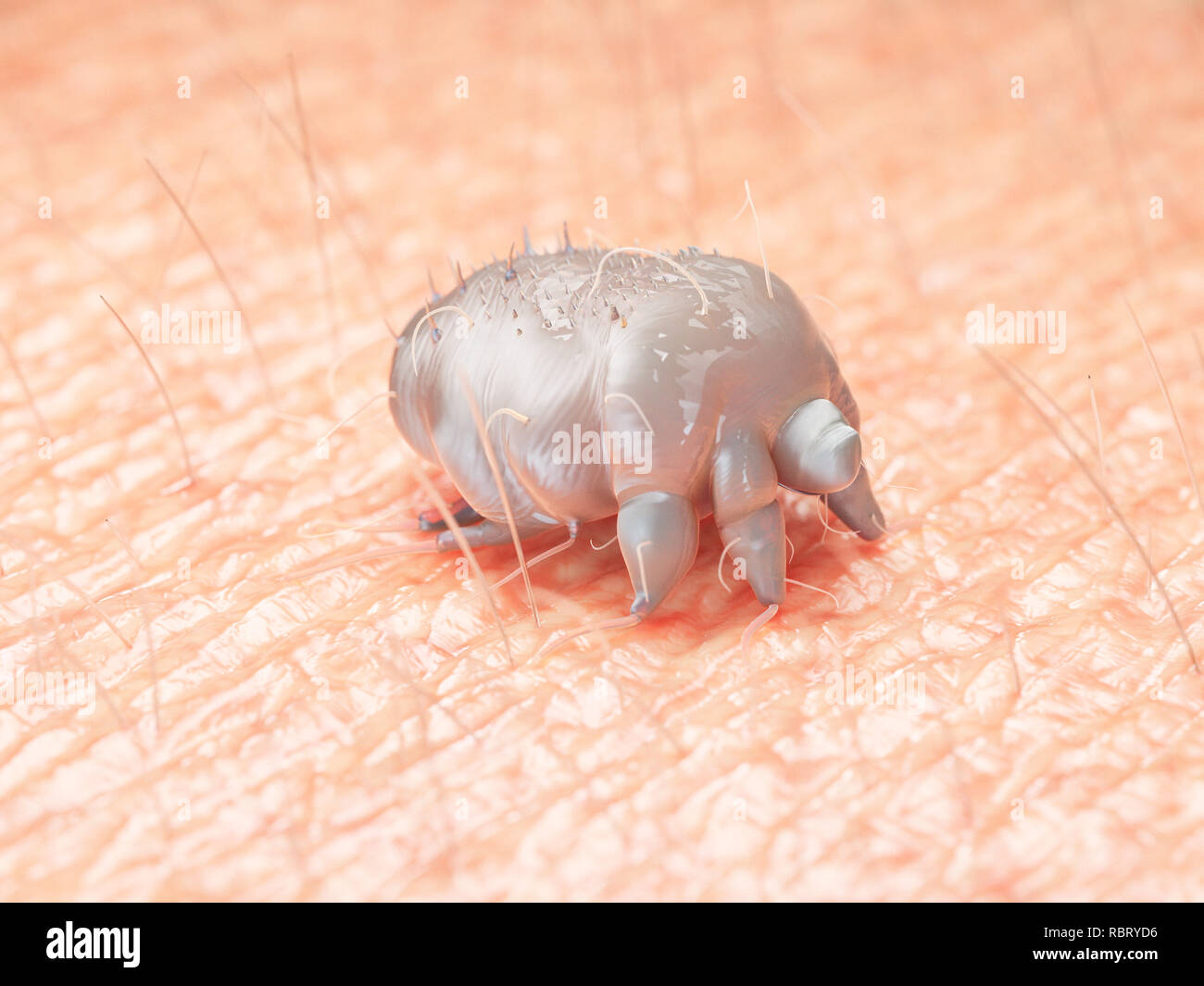 Illustration de l'un des acariens de la gale sur la peau humaine. Banque D'Images