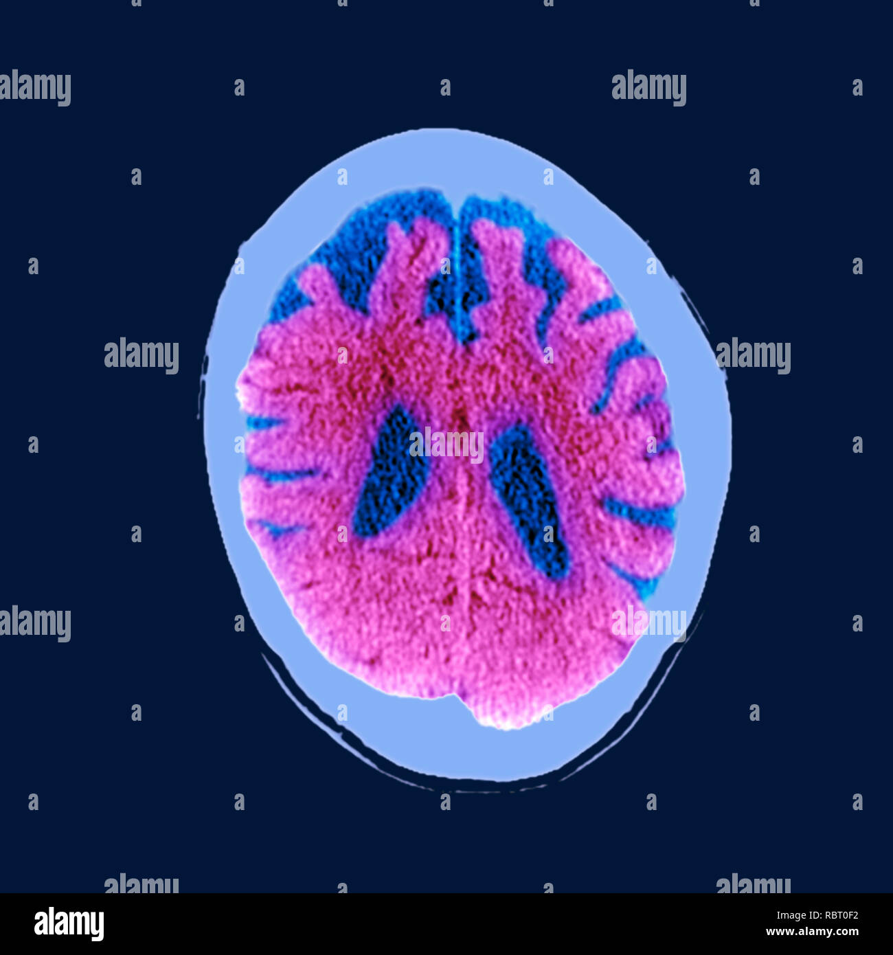 Le cerveau dans la démence. La tomographie de couleur (CT) d'une section à travers le cerveau d'un 89-year-old male patient souffrant de démence. Le cerveau a atrophiées (réduites), illustré par les ventricules centrale élargie (bleu foncé) et entailles profondes autour des bords du cerveau. Banque D'Images