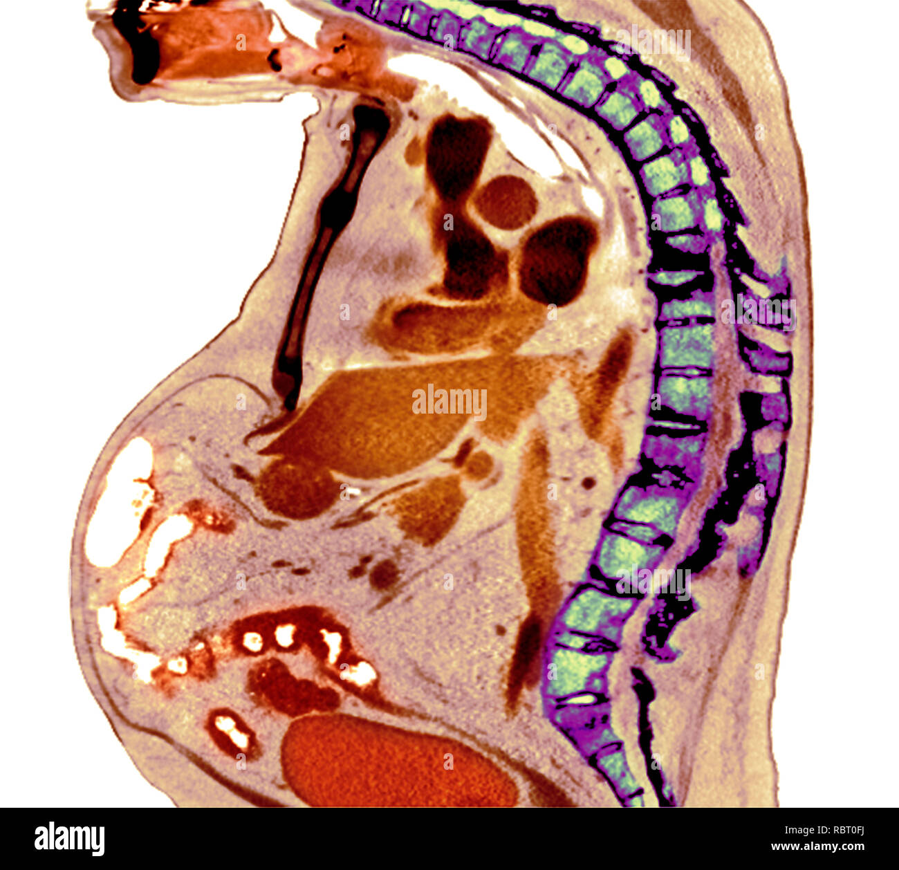 Colonne vertébrale dans la spondylarthrite ankylosante. X-ray de couleur d'une section à travers la colonne thoracique d'un 74-year-old male patient avec la spondylarthrite ankylosante, sho Banque D'Images