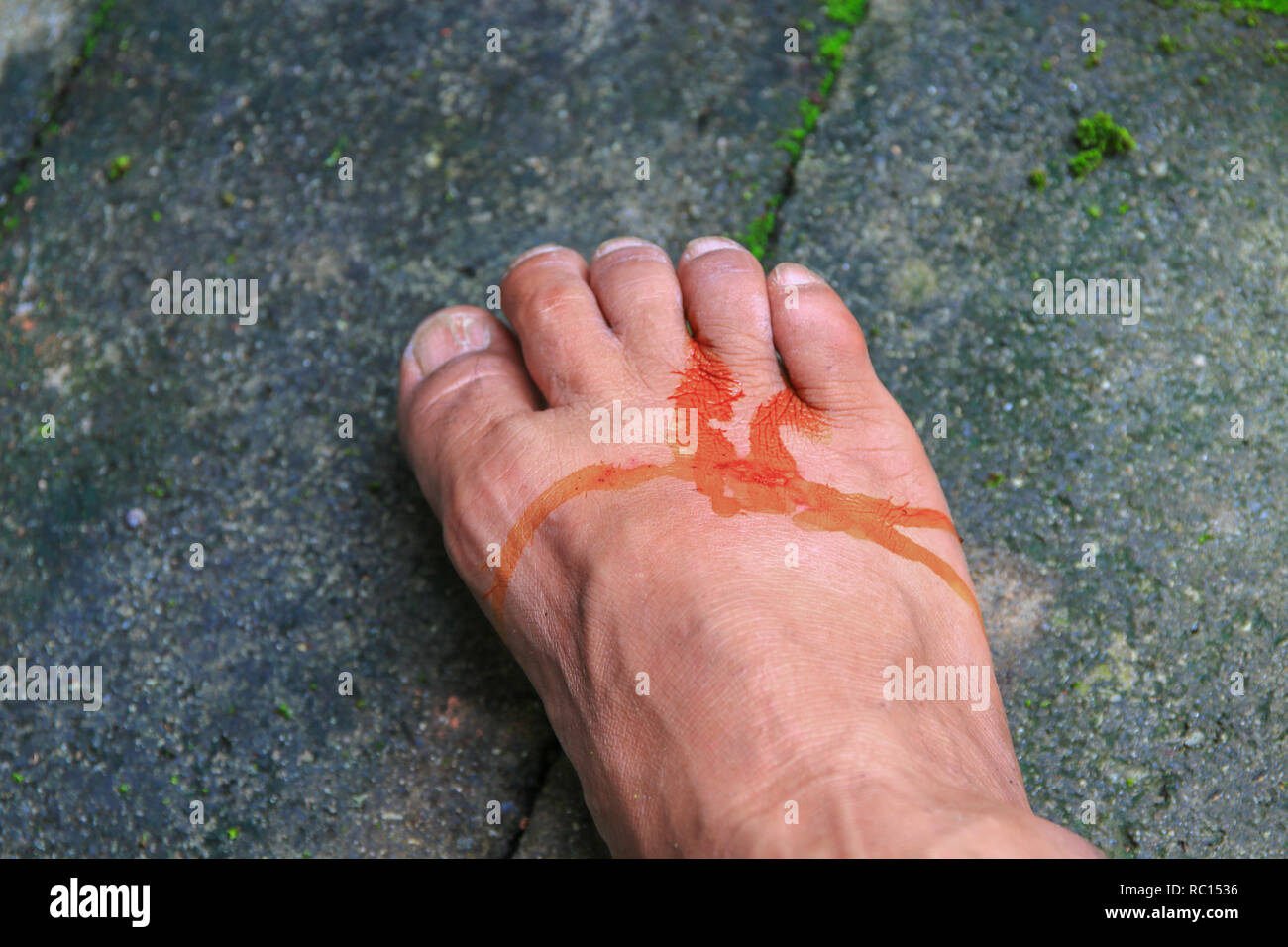 La plaie du pied est infecté par appliquer ces médicaments sélectionner focus avec une faible profondeur de champ. Banque D'Images