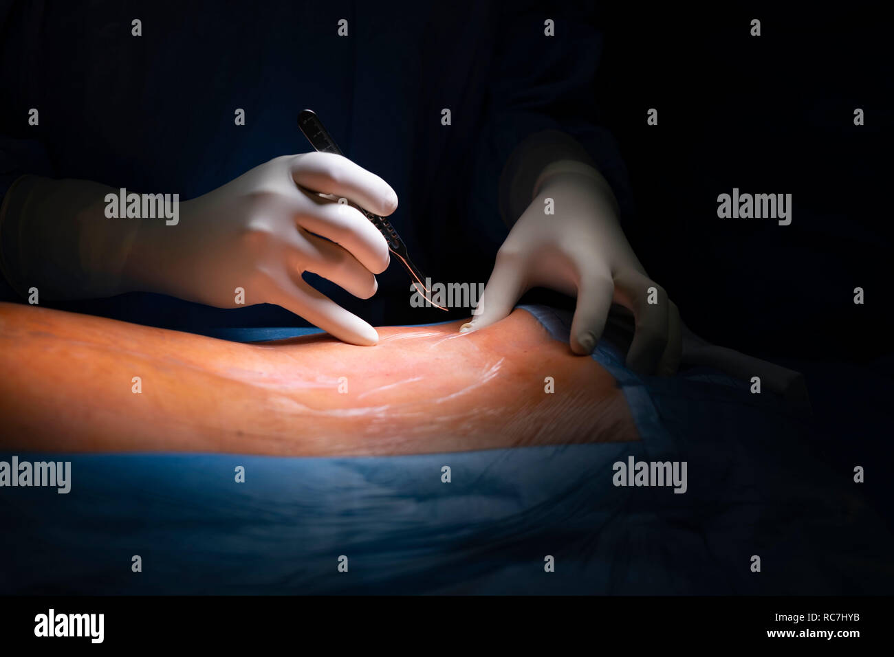 Détail de chirurgien attente pour effectuer la première coupe avec un scalpel au cours d'une chirurgie à l'hôpital salle d'opération Banque D'Images