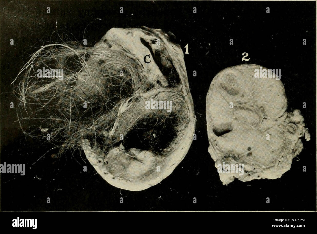 . Les maladies des organes génitaux des animaux domestiques. La médecine vétérinaire. 256 jo Maladies des organes génitaux. Fig. 70a-Kyste Dermoïde de l'ovaire. Mare. / Cystit, ovaire, le kyste d'être rempli de poils emmêlés. loug C, du cartilage ; 2, de l'ovaire normal même animal.. Veuillez noter que ces images sont extraites de la page numérisée des images qui peuvent avoir été retouchées numériquement pour plus de lisibilité - coloration et l'aspect de ces illustrations ne peut pas parfaitement ressembler à l'œuvre originale.. Williams, Walter Long, 1856- [from old catalog] ; Williams, Walter Wilkinson, 1892- [from old catalog] du conjoint Banque D'Images