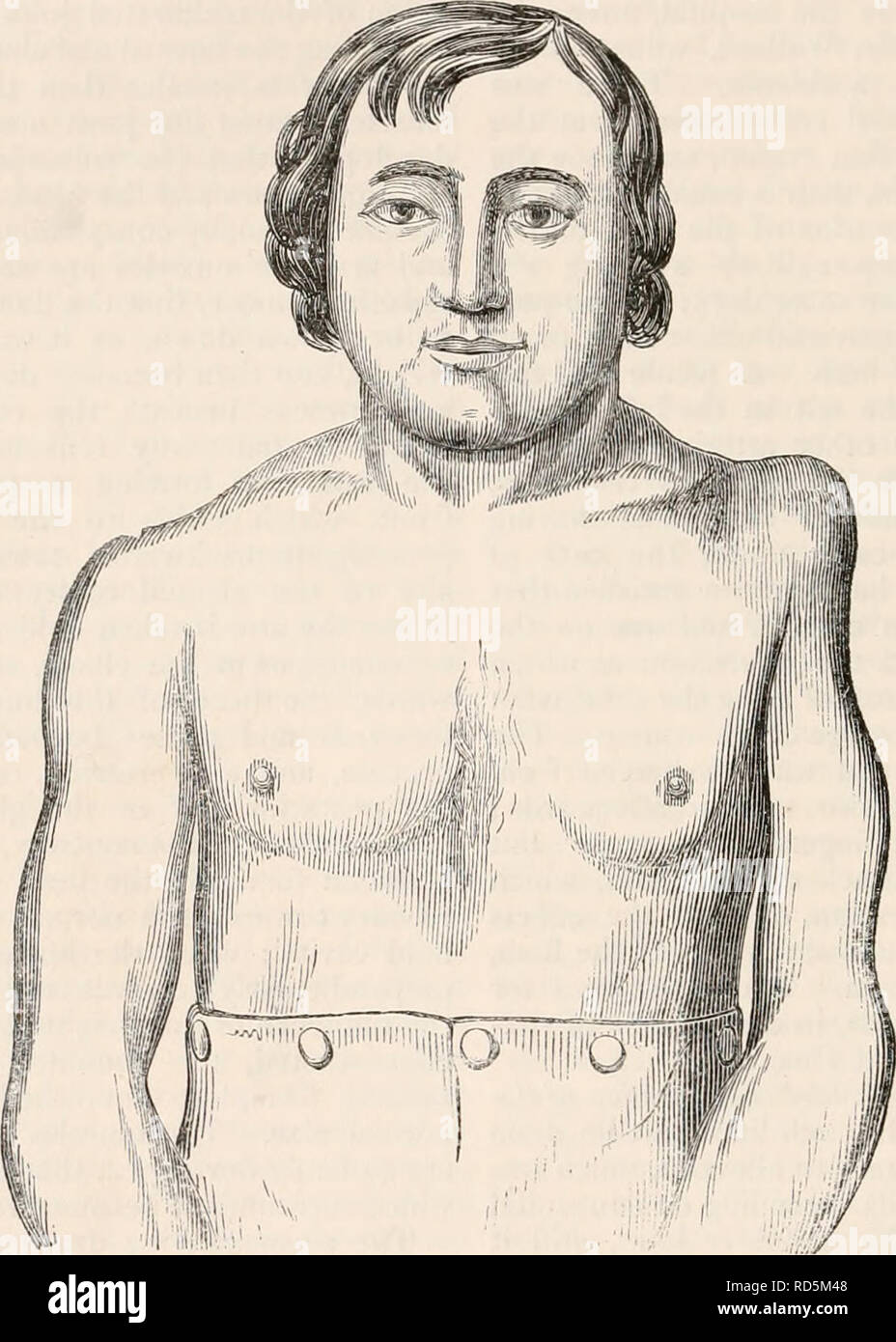 . La cyclopaedia d'anatomie et physiologie. Anatomie ; physiologie ; Zoologie. 618 DES CONDITIONS ANORMALES DE L'articulation de l'épaule. Aussi adductecl légèrement vers la ligne médiane. Lorsque l'épaule est vue par l'arrière une dépression correspondant à la situation de la moitié postérieure de la cavité glénoïde est observable : dans cette dépression la sonnerie peut être coulé jusqu'à atteindre la surface de la partie postérieure de la cavité glénoïde. Lorsque le bras est tiré vers l'avant sur la poitrine, la tête de l'humérus passe en arrière sous l'acromion, et une dépression peut être ressenti devant sous le cora Banque D'Images