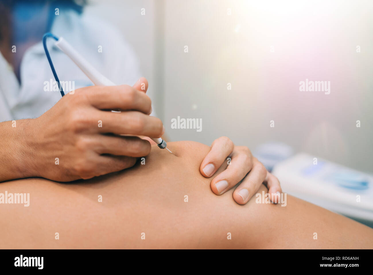 Aiguille aiguille sèche Electroacupunture raccordement de la machine à des aiguilles utilisées par acupunturist sur patient pour l'acupunture guidée par Intratissue Percutane EPI Banque D'Images