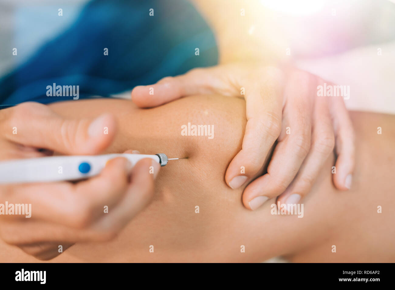 Aiguille aiguille sèche Electroacupunture raccordement de la machine à des aiguilles utilisées par acupunturist sur patient pour l'acupunture guidée par Intratissue Percutane EPI Banque D'Images