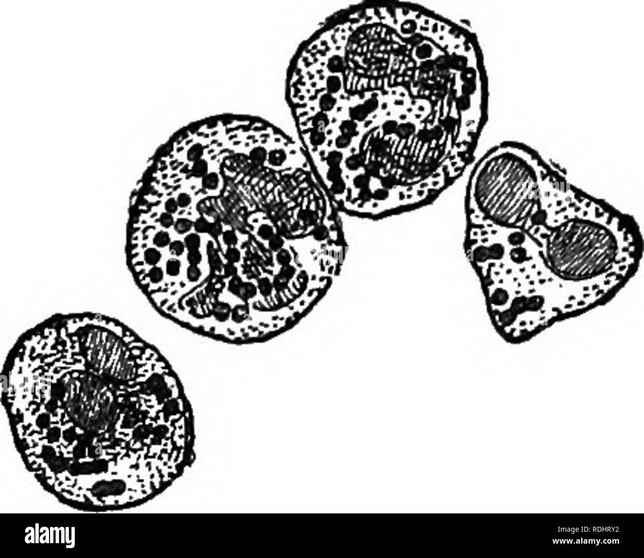 . Les microbes, fermente et moules . Les bactéries ; Champignons ; la fermentation. 234 MICEOBES FEEMENTS, ET DES MOULES. XV. Les microbes de pus ; Pyemia et septicémie. Des plaies et des opérations chirurgicales sont souvent suivis d'un empoisonnement général de tte le sang et de l'ensemble du système-une grave affection qui est mortelle, et qui se caractérise par la présence de pus dans les corpuscules de con- siderable nombre dans le sang et dans les organes principaux. Avec ces globules de pus il y a toujours un microbe spécial, appelé Micrococcus septicus, qui, comme celui de la diphtérie, peut apparaître soit gratuitement ou sous la forme de chapelets (v Banque D'Images