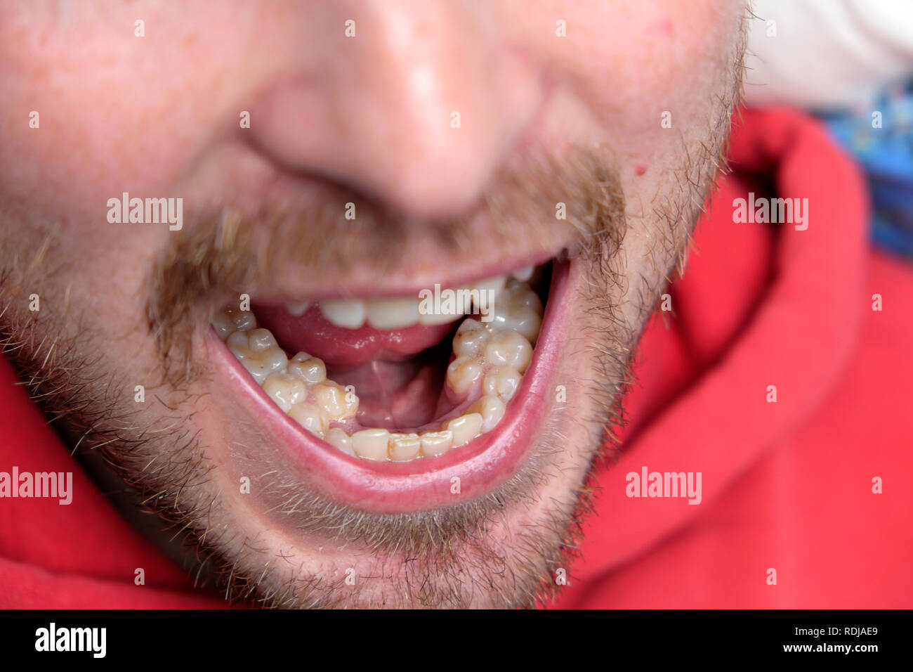Un jeune homme avec la bouche ouverte montrant son jeu supplémentaire de prémolaires molaires dents prémolaires surnuméraires au Pays de Galles UK KATHY DEWITT Banque D'Images