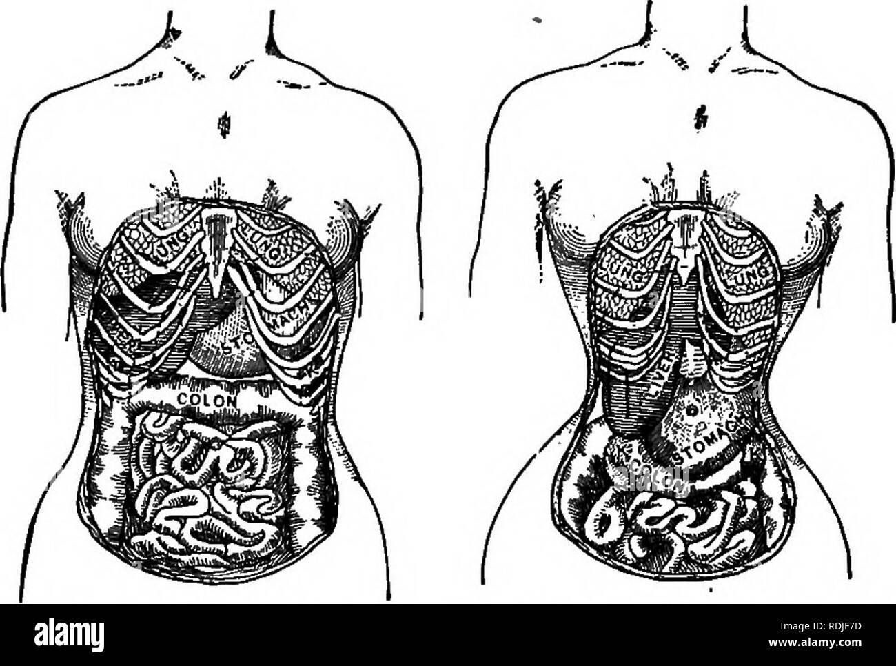 . La biologie élémentaire, animale et humaine. La biologie. 148 LA BIOLOGIE HUMAINE la croissance. La matière minérale m nos aliments sont ensuite solubilisés et sont ensuite fournis par le sang pour les cellules osseuses qui, en retour, les convertir cette matière minérale dans la substance intercellulaire. 216. Effet de la pression sur les os. - Vêtement serré est un facteur le plus important dans la modification de la forme de façon permanente et po- tion des os. La croissance normale ne peut être atteint si le squelette est soumis à une pression. Pourtant, cet important principe de l'hygiène est constamment violés par des femmes qui portent des vêtements trop serrés. A  = N Banque D'Images