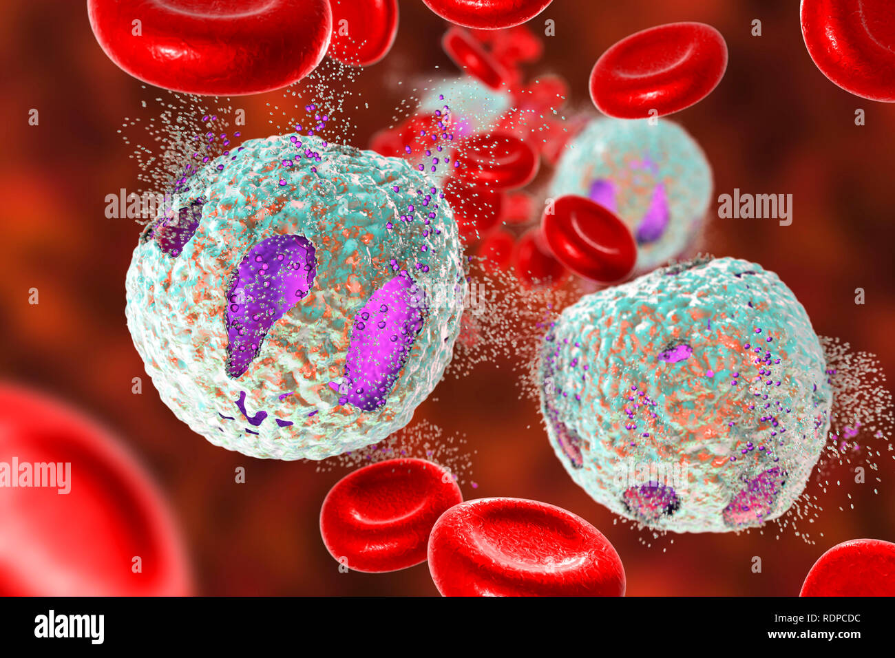 Leucemie Aiguë Lymphoblastique Banque De Photographies Et Dimages à