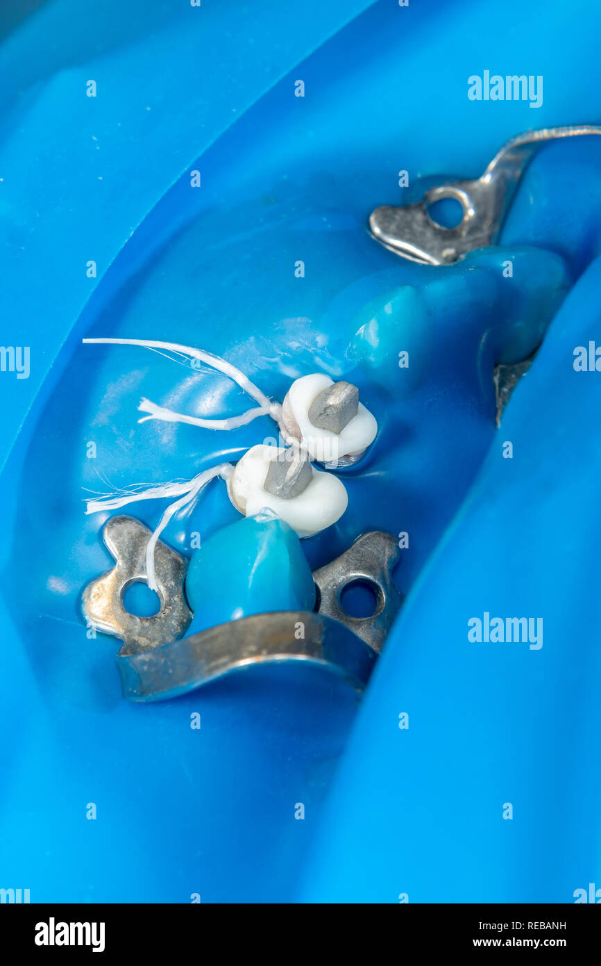 La restauration dentaire de la pourriture des racines des dents avec des couronnes en céramique. cast posts dentistry Banque D'Images