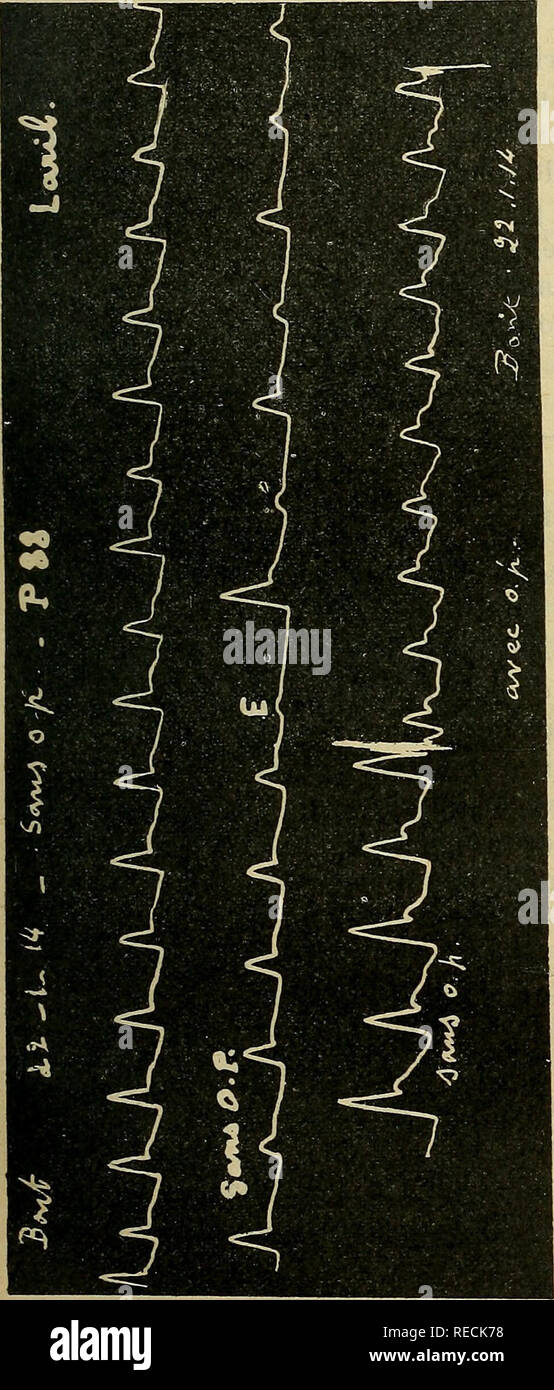 . Comptes rendus des sÃ©ances de la SociÃ©tÃ© de biologie et de ses filiales. La biologie. SÃANCE DU 28 MARS 343 Le tracÃ© montre que dans ce cas l'excitation du X a favorisÃ© l'appa- rition d'une extrasystole E, restaurant à la suite de laquelle l'alternance a Ã©tÃ© accentuÃ©e pour un petit nombre des rÃ©volutions cardiaques consÃ©cutives. Deux autres malades (^tracÃ©s Bont. et Larib, 17-1-14) prÃ©sentaient une persistance du pouls alter- nant bien que le traitement diÃ©tÃ©tique prolongÃ© aci nota- blement amÃ©liorÃ© leur Ã©tat ; tous deux avaient un R. O.C. absolument normal et se trou- vaient bien de la d Banque D'Images