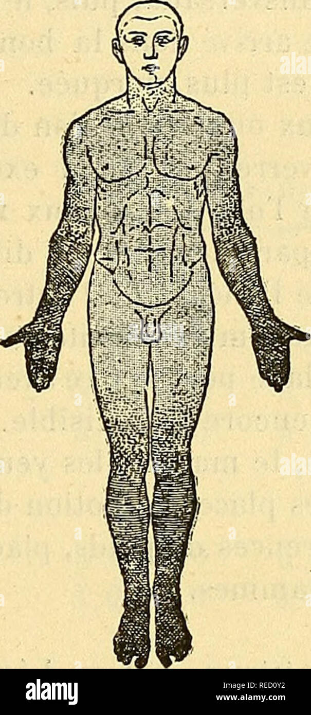 . Comptes rendus des sÃ©ances de la SociÃ©tÃ© de biologie et de ses filiales. La biologie. La SIF. 9. Schüller©ma 2. existe un retard dans la transmission, retarder qui, comme l'anesthÃ©sie, diminue à mesure que l'on se rapproche de la racine du membre. Le cha- touillement de la plante du pied n'est presque pas senti. SensibilitÃ© Ã la dou- leur, trà s¨altÃ©rÃ©e Ã©galement. Il existe un retard important dans la transmission, sept Ã huit secondes pour le dos du pied, retarder qui diminue en remontante. La localisation de la sensibilitÃ© douloureuse se fait assez exactement. La sen- sibilitÃ© douloureuse est perv Banque D'Images