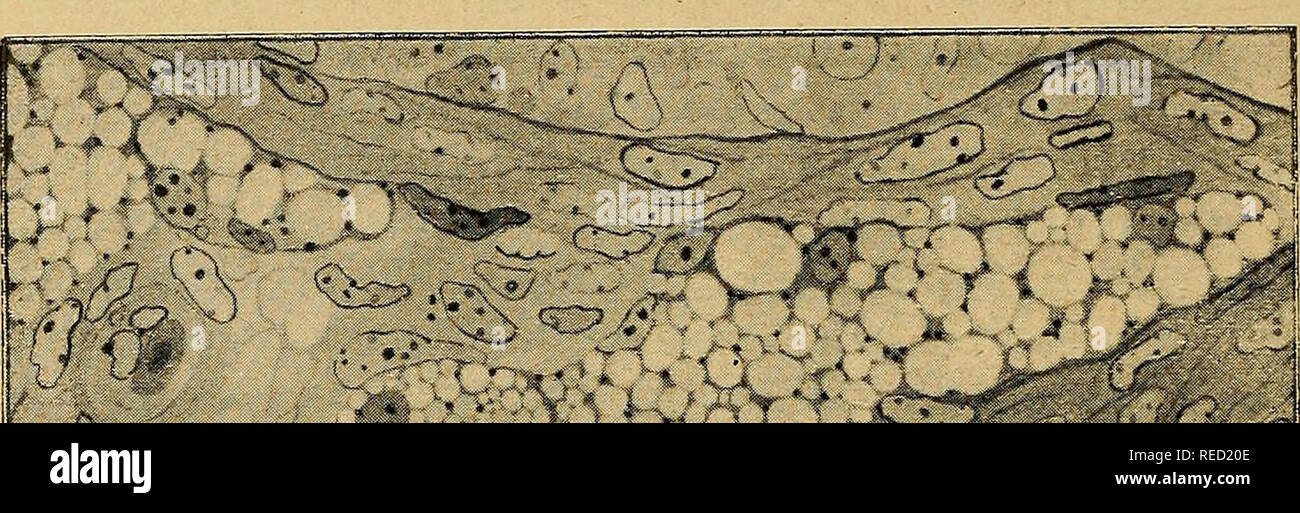 . Comptes rendus des sÃ©ances de la SociÃ©tÃ© de biologie et de ses filiales. La biologie. 1384 RÃUNION BIOLOGIQUE DE STRASBOURG l54 ; the le diagnostic. DÃ© plus, son cytoplasme est dense, et contient certaines enclaves caractÃ©ristiques que l'acide acÃ©tique n'altÃ¨re pas. Rien de semblable chez le coq. La cellule interstitielle n'est reconnaissable que par son protoplasme Ã©laborateur et son matÃ©riel Ã©laborÃ©, et lorsque ceux-ci sont trà s¨bien conservÃ©s. Dans le cas contraire, elle ressemble Ã une cel Iule conjonctive banale, le plus souvent encore bien endom- magÃ©e. '. Banque D'Images