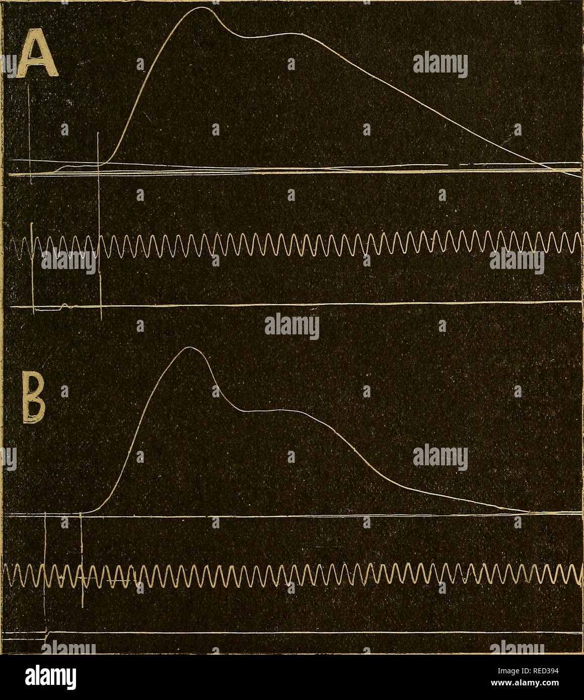 . Comptes rendus des séances de la Société de biologie et de ses filiales. La biologie. (39) SÉANCE DU I MARS 540 l'homme et chez le chien, dans le cas d'activité motrice directe provoquée par l'électrique d'excitation du nerf du muscle ou de son moteur. Chez l'homme, de notre technique a consisté à porter l'excitation faradique sur la cuisse du sujet, soit par le bouton même du myo-. Fig. i.  Homme : A. Gonflement du quadriceps par choc rotulien.  B. Gon- flement du muscle même électrique d'excitation par point du moteur du vaste externe. graphe, soit par une électrode exploratrice distincte, Banque D'Images
