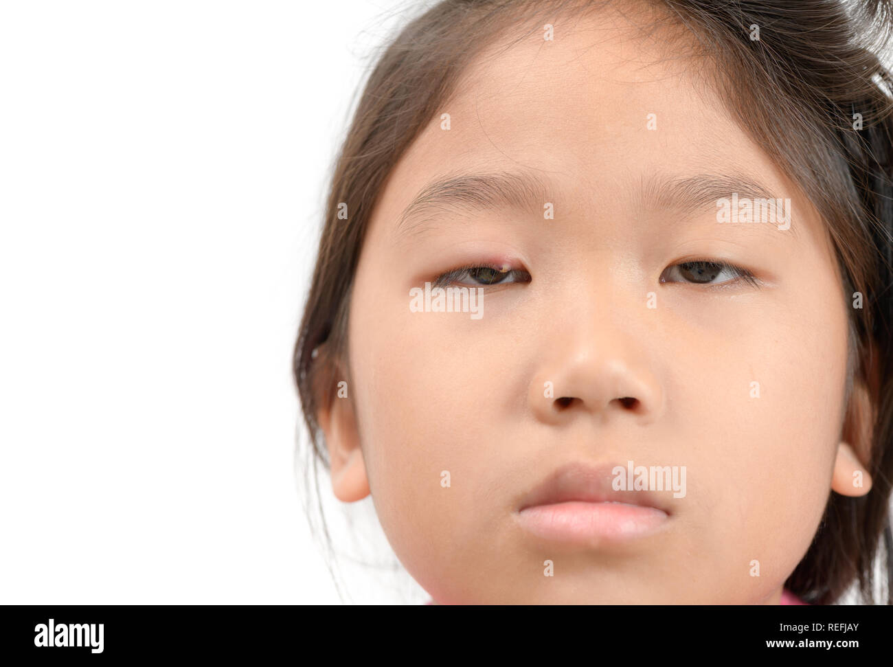 Chalazion Banque D Image Et Photos Alamy Chalazion Banque D Image Et Photos Alamy