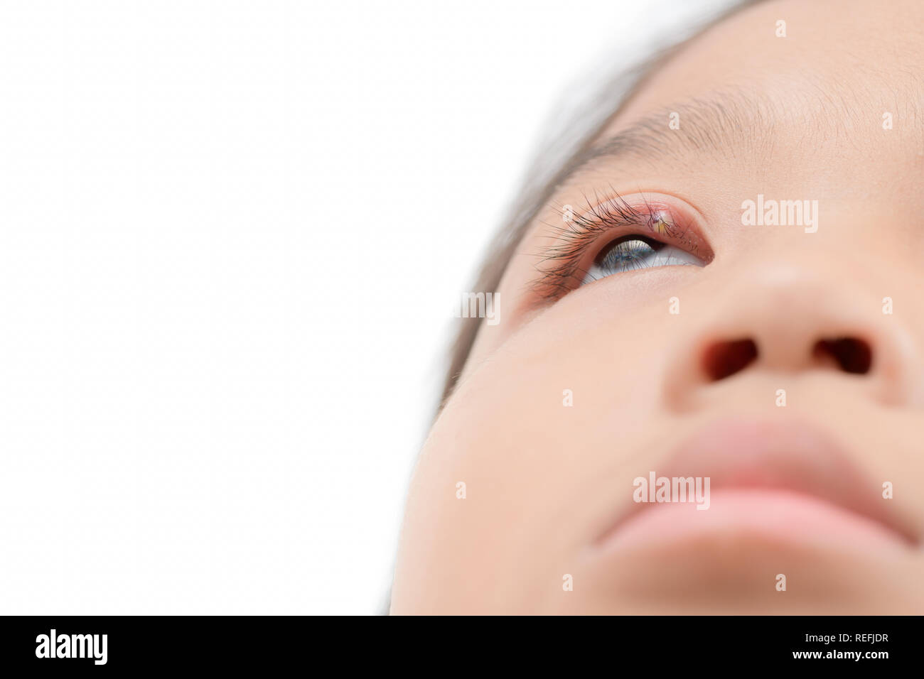 Chalazion Banque D Image Et Photos Alamy Chalazion Banque D Image Et Photos Alamy